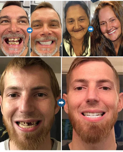 Strong Suction Full Denture for Confident Smile