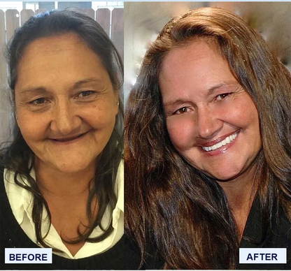 Strong Suction Full Denture for Confident Smile